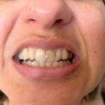 Dentes desgastados pelo tempo