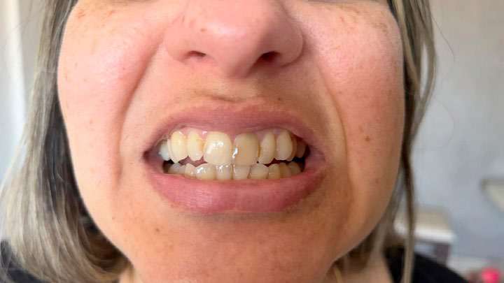 Close de um sorriso com dentes desgastados e amarelados