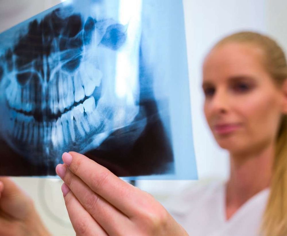 Enxerto ósseo e implantes: entenda quando ele é necessário