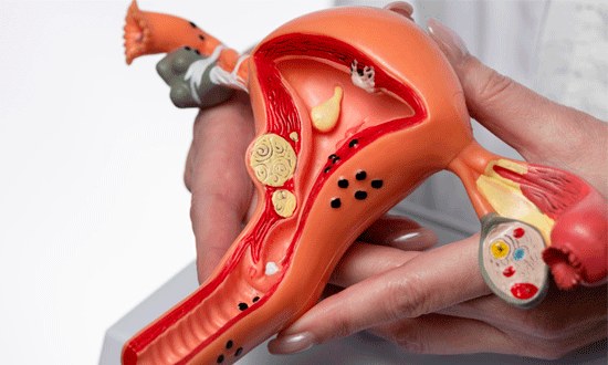 Modelo anatômico do útero com dispositivo intrauterino