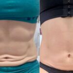 Flacidez abdominal