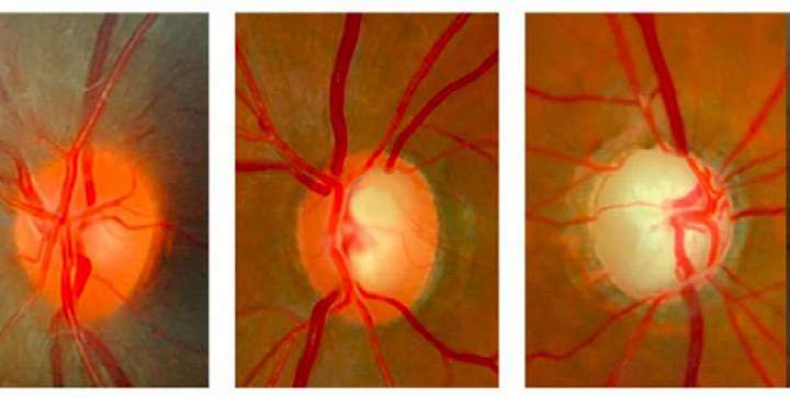 Três imagens de fundo de olho mostrando estágios do glaucoma no nervo óptico