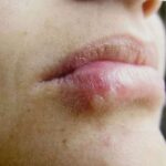 Lábio com lesão de herpes labial