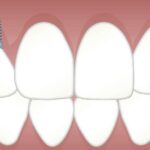 Ilustração de implante dentário entre dentes naturais