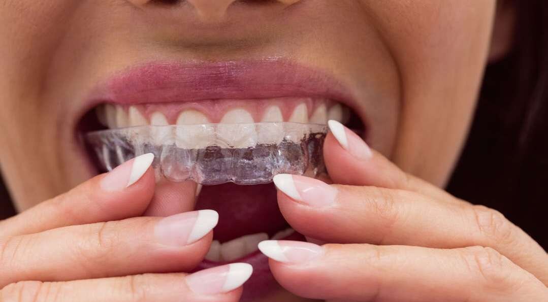 Mulher encaixa placa transparente nos dentes