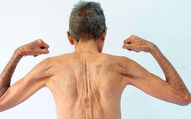 Sarcopenia